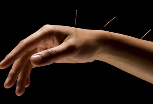 acupuncture.jpg